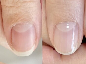 ニコワイズネイル(Nico Y's Nail)の写真/「爪を見られるのが恥ずかしい」そんな方へ。深爪・爪噛み・剥離もご相談ください