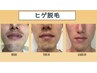 メンズひげ脱毛　幹細胞パック付き　1回　¥3000円