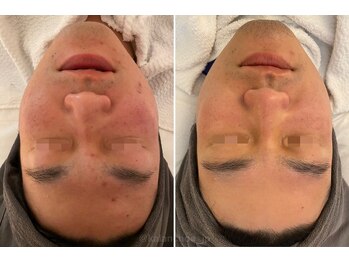 カランコエ(KALANCHOE)/トラブル・赤みに！