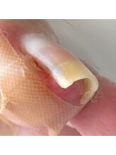 001 新横浜/痛い巻き爪も一回で