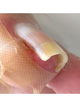 痛い巻き爪も一回で