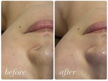 ビアス(Biasu)/小鼻の黒ずみ解消!肌質改善☆