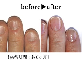 リング ザ ベル(ring the bell)/深爪プレミアムコース¥18,700