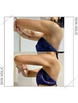 スキンホリック 恵比寿駅前店(SKIN HOLIC)/二の腕☆ビフォア＆アフター