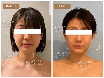 アセンド(ASCEND)の写真/筋肉、骨格矯正だけでなく、リンパケアまで叶う次世代コルギ(コルグン)で小顔が続く&透明感も◎
