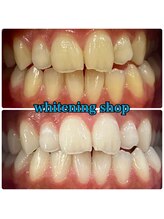 ホワイトニングショップ 鈴鹿店/Before&After美白ホワイトニング