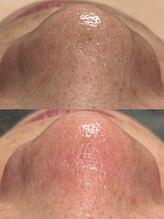 アットウィル 志木店(at will)/毛穴洗浄BeforeAfter