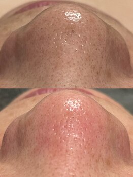 アットウィル 志木店(at will)/毛穴洗浄BeforeAfter
