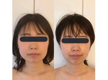 ハイコガオ(HIKOGAO)/小顔矯正60分