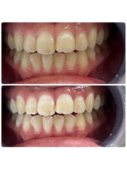 グリッター ショウナン(glitter. SHONAN)/藤沢ホワイトニングbefore/after