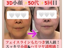 マール(Mar)/ビフォーアフター　小顔/たるみ