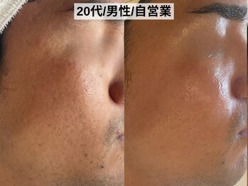 ハナコ 健軍店(HANAKO)/毛穴、跡