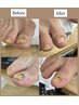 【足の爪切り補修】巻き爪・分厚い爪・変形爪・足のケア