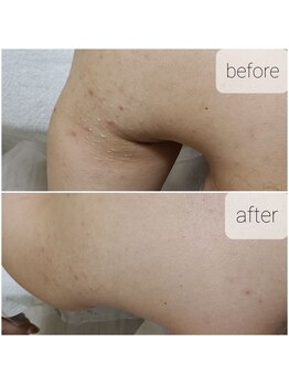 アジュール(a jour)/背中、二の腕ハーブピーリング