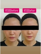 ゆうはり鍼灸整骨院 恵比寿/お客様Before　After