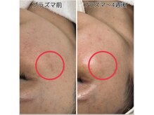 シェクラ(SHECIA)/シミケア★