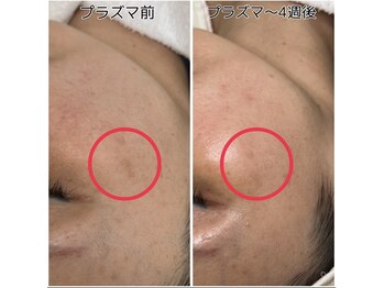 シェクラ(SHECIA)/シミケア★