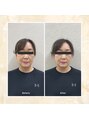 プレメ 人形町院(The Preme) くびケアスリム症例※許可なく掲載しません。