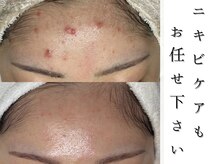 ジョンミー(JONMEE)の雰囲気(韓国最新ダクトピールで毛穴・ニキビケア!銀座一丁目.ニキビケア)