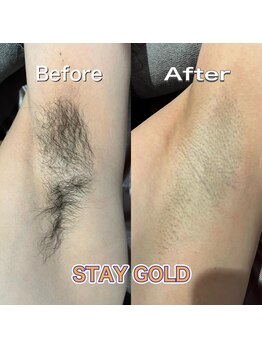ステイゴールド 新百合ヶ丘(STAY GOLD)/ワキ脱毛も勇気がいりますよね!