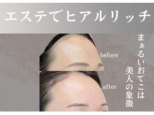 クリニカルボーテ 心斎橋院(CLINICAL BEAUTE)の雰囲気（美容医療提携の特許技術★ヒアルロン酸導入で理想のパーツが叶う）