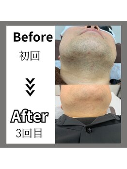 ミライキング(mirai king)/ビフォーアフター