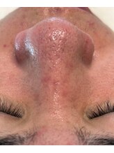 ルチル(Rutile)/韓国式3D毛穴洗浄