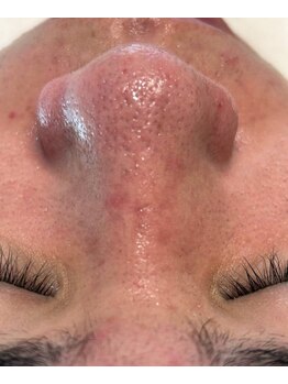 ルチル(Rutile)/韓国式3D毛穴洗浄