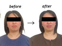 もみの木鍼灸整骨院 恵比寿/初回のみ美容鍼ビフォーアフター
