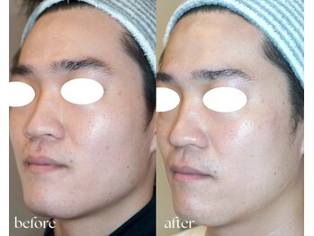 岩川治療院/ハイブリッドコース施術3回