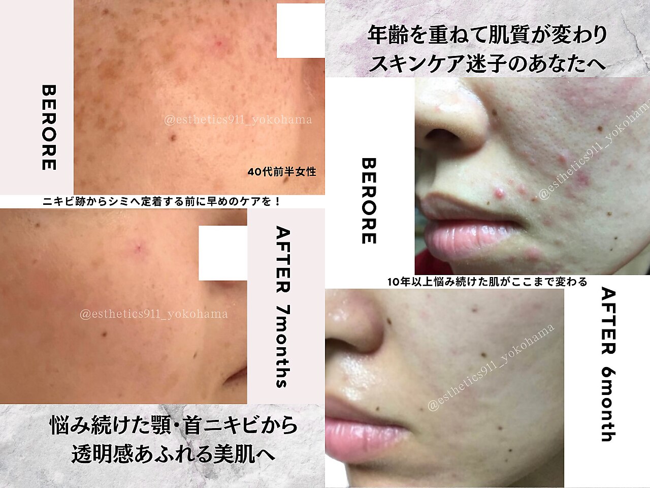 肌質改善エステサロン♡ エステティックス ナインワンワン 横浜(Esthetics911