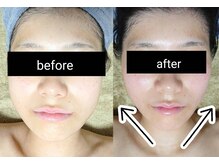 ラフォスでコラーゲン生成促進しハリと弾力ある引き締った小顔