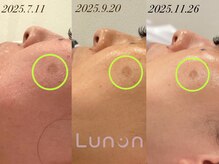 ルノン(Lunon)/毛穴洗浄ハイドロ×ララピール