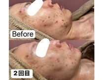 チュベルフェ(tu belle fe)/羊膜幹細胞◆水光ジェット◆