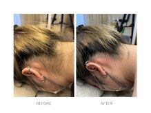 エルピス(ELPIS)/うなじMIX脱毛