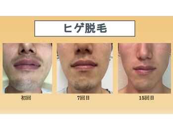 カラー(COLOR)/メンズ脱毛/ヒゲ脱毛