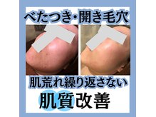 毛穴屋の雰囲気（毛穴洗浄後、光マシンで毛穴引き締め毛穴洗浄エクストラクション）