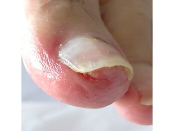 痛い巻き爪も一回で