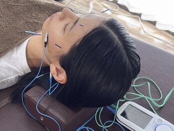 ルーツ 熊本院(Roots)の写真/FN美容鍼×ヒト幹細胞美容液の注入を同時に施術◇肌質改善、エイジングケアに◎うるおいのあるお肌へ♪