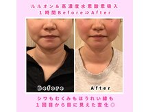 ヨサパーク ピスティー(YOSAPARK Pisty)の雰囲気（高濃度水素酸素吸入で痩せるスピードUP★小顔.しわ.たるみケア◎）