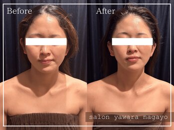ヤワラ 長与店(yawara)/πテラピーBefore After