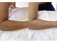 リノ(Lino)/メンズ肘下☆脱毛☆