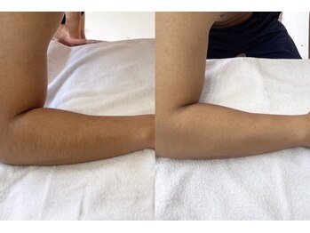 リノ(Lino)/メンズ肘下☆脱毛☆