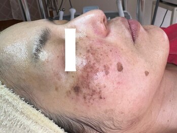 プリエ(Prier)の写真/<写真の様な肌も1回の施術でこんなにも変わる★>しつこいシミを最速ケア◎劇的ビフォーアフターチェック♪