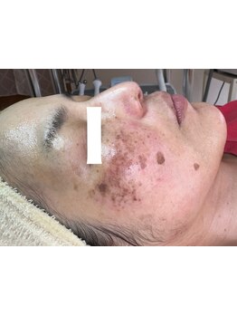 シミしわ改善！予防ケア