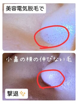 ベビースキン(baby skin)/美容電気脱毛