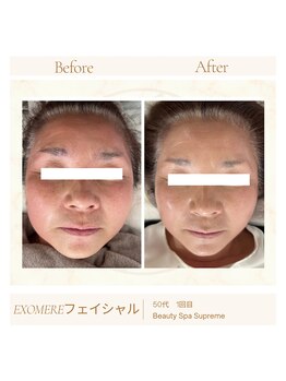 シュプレーム(Supreme)/エクソミアフェイシャル/毛穴無