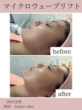 ココ(COCO)/マイクロウェーブリフト/小顔