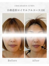 ルミア(LUMIA)/小顔造形ロイヤルフルコース１回