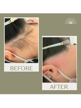 ムー 表参道店(mou)/うなじダブル脱毛before&after 